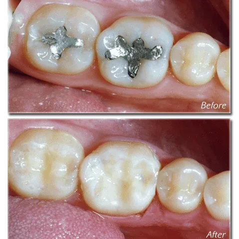 Composite Restorations