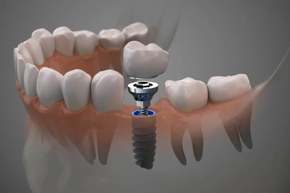 Dental Implants