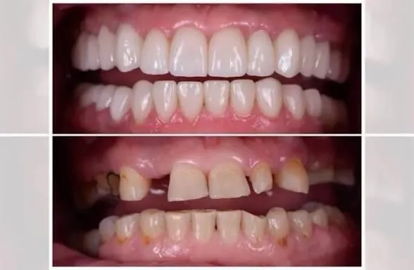 Full Mouth Rehabilitation