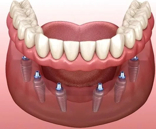 Implant Supported Dentures