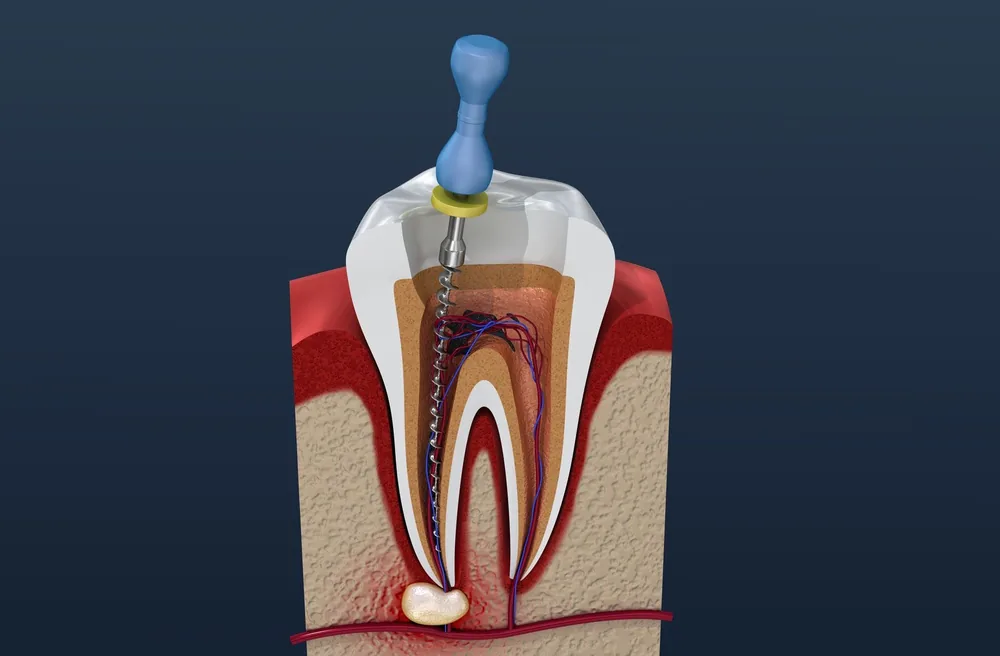 Root Canal Treatment