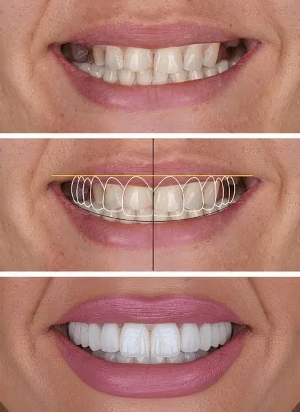 Smile Designing