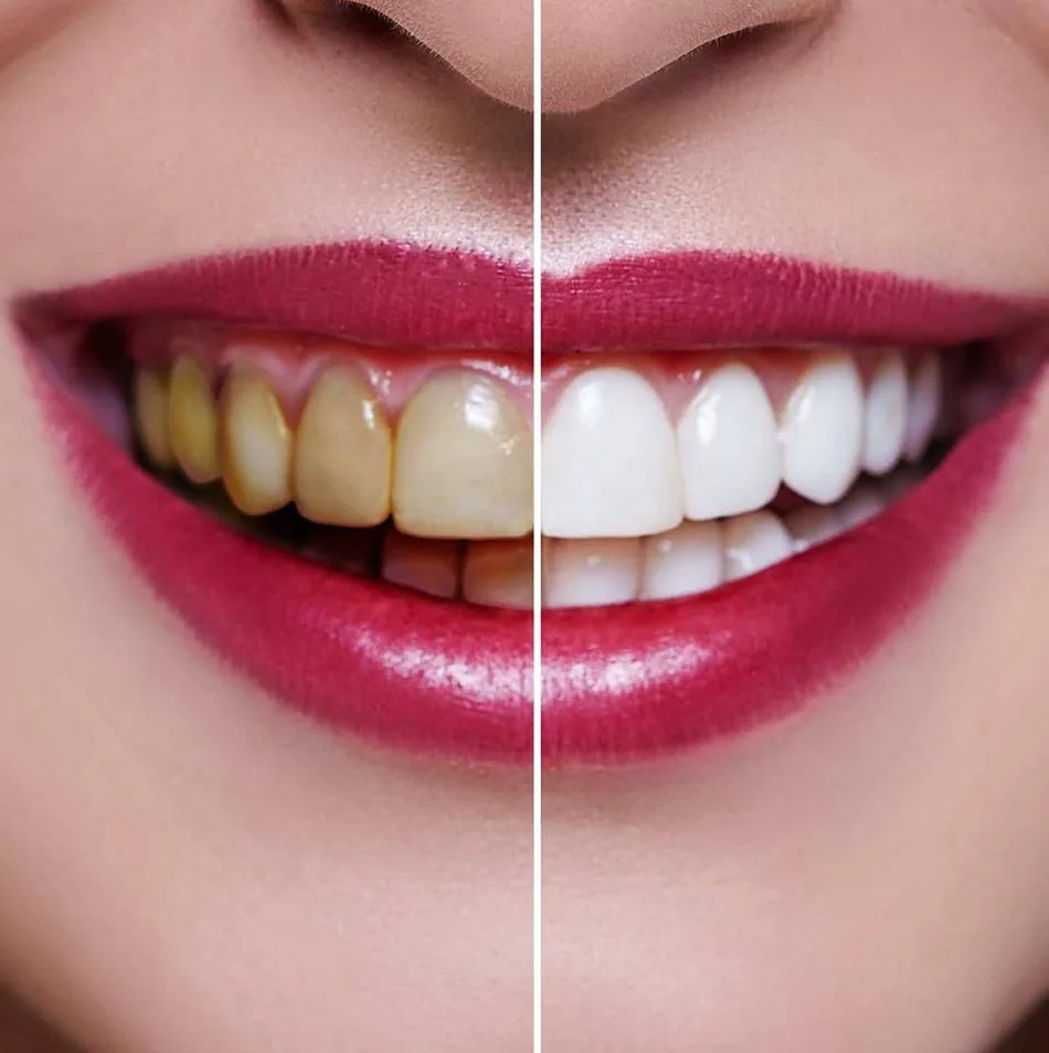 Teeth Whitening