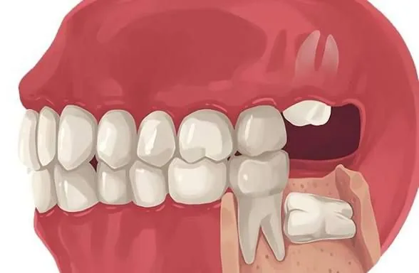 Wisdom Tooth Removal (Disimpaction)